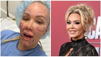 Bunnie Xo before surgery (left); Bunnie Xo on the red carpet