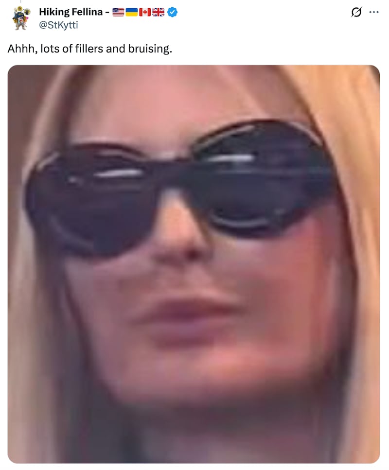 X user sees lip fillers and bruising in pictures of Ivanka