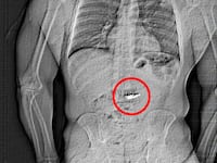 Orlando police released an x-ray image that appeared to show a foreign object in the suspect's abdomen.