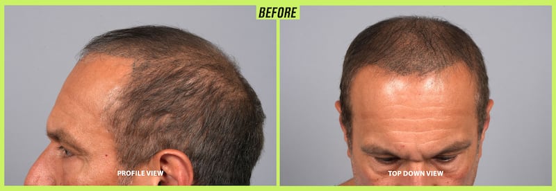 Male hair transformation before and after