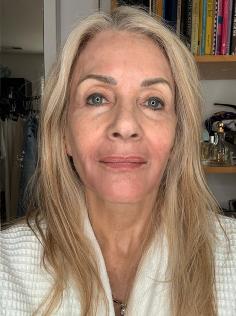49 days after the treatment, Pamela Allyn saw clear improvement in her skin texture.