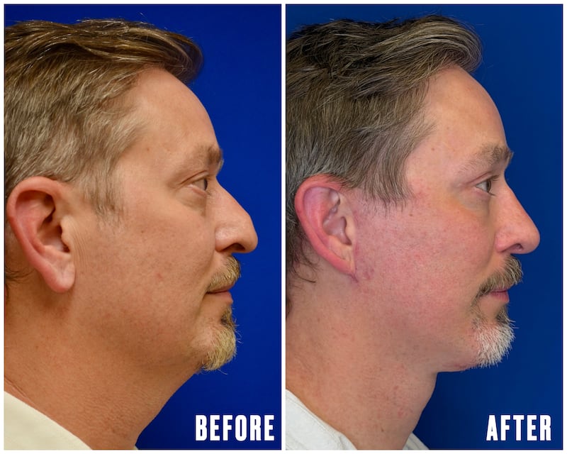 For His 50th Birthday, He Got Six Plastic Surgery Procedures for The Looker