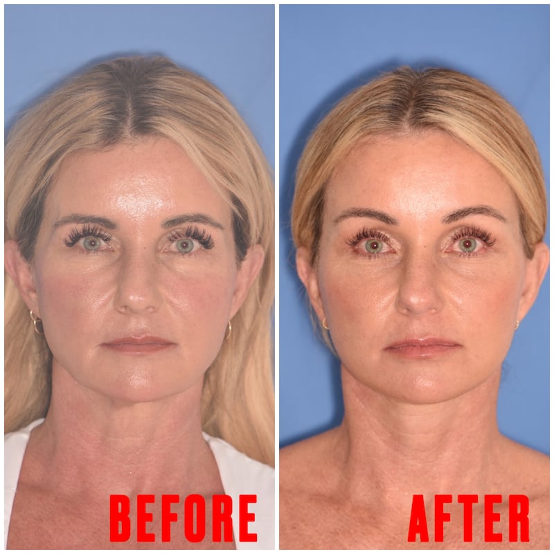 Chari Pack, 51, gets facelift after kids leave home.