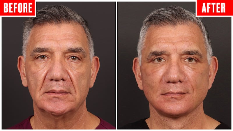 Before and after photos showing a couple who got face lifts