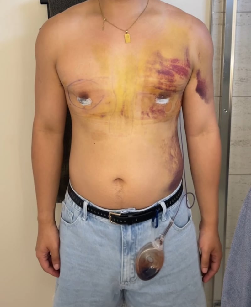 Jon Michael during recovery.