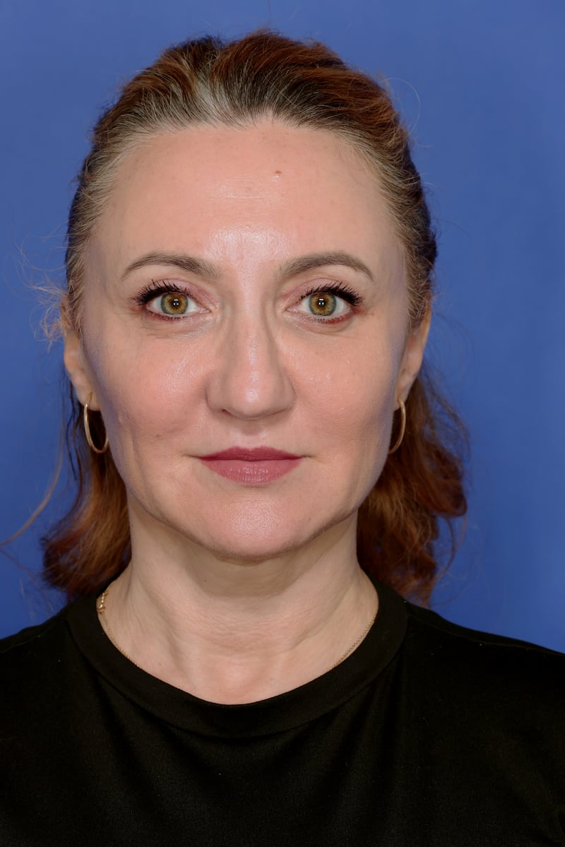 After two months, the results had settled in, and Dr. Bachilo's client looked radiant and natural.