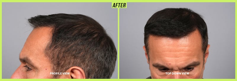Male hair transformation before and after