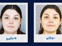 A photo illustration of chin lipo suction before and after for the Looker.