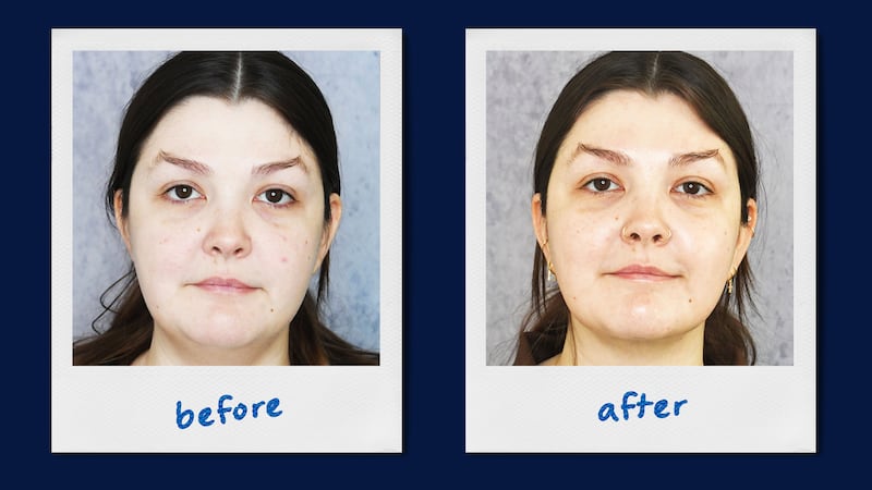 A photo illustration of chin lipo suction before and after for the Looker.