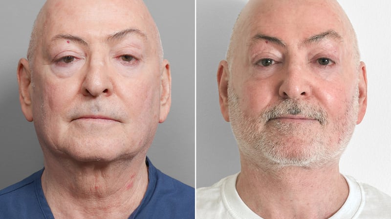 David's jawline before and after. Front view