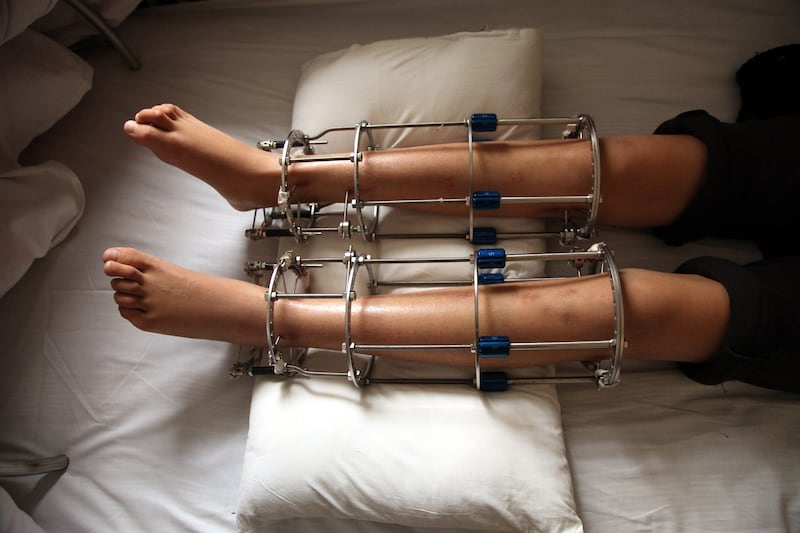 A patient recovers after surgery at the Institute of External Skeletal Fixation in Beijing, China.