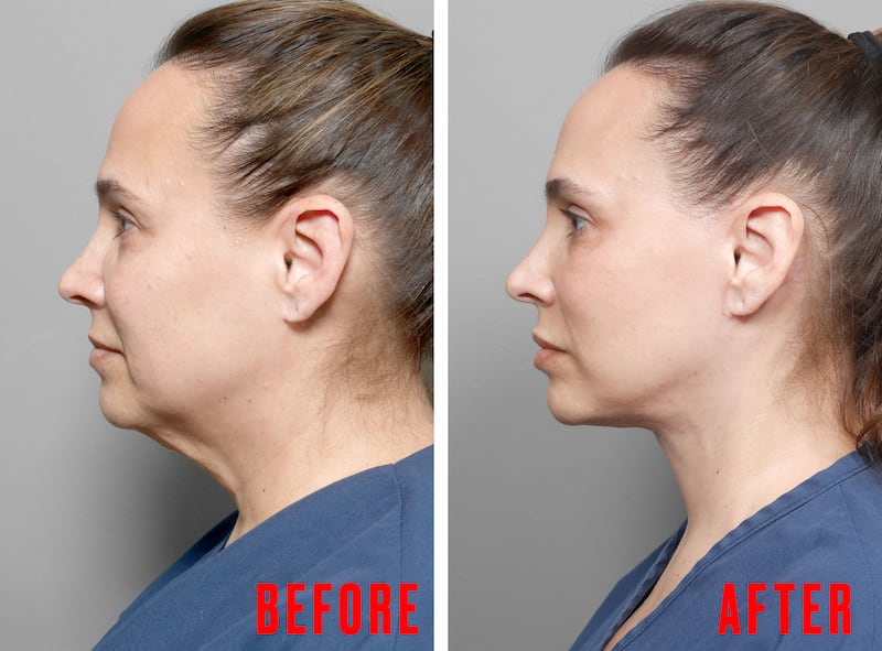 Woman Gets a Facelift After Losing 80 Pounds on GLP-1s for the Looker.