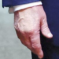 Trump’s hand, covered in makeup, as he left King Charles and Queen Camilla at Windsor Castle on his state visit to Britain.