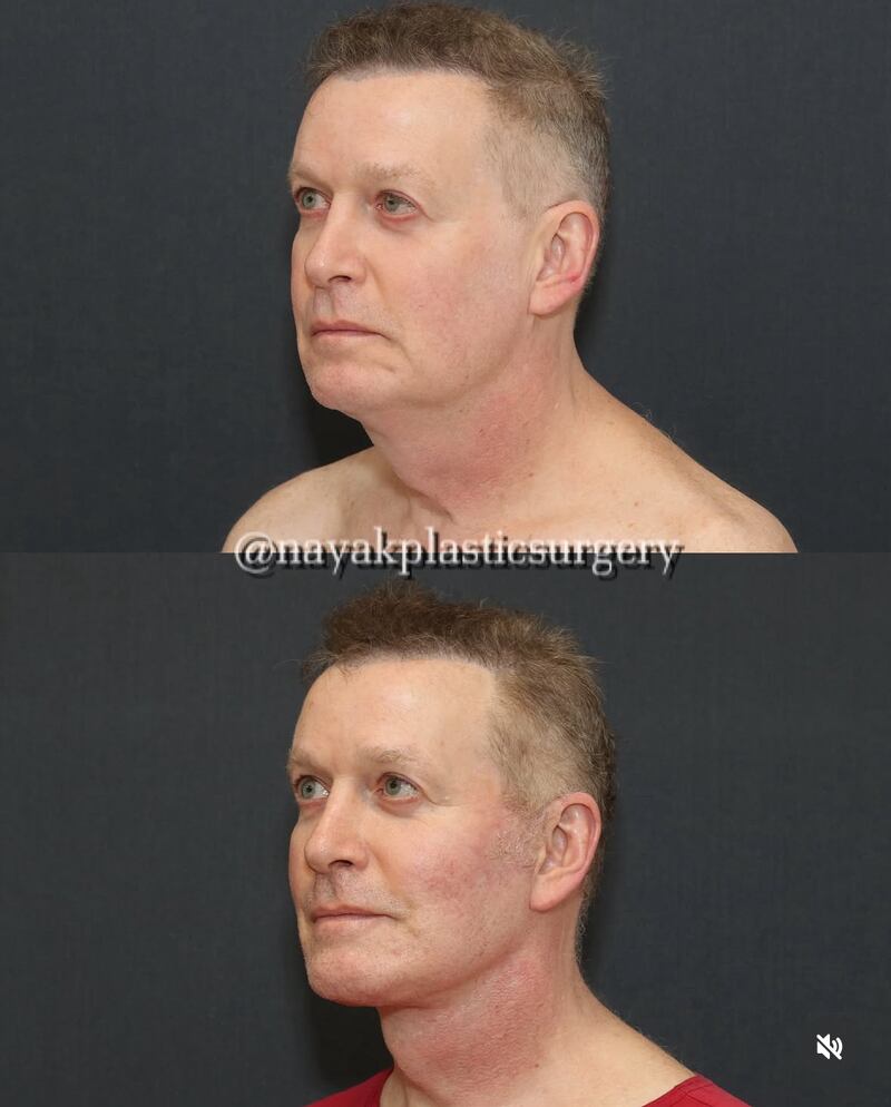 John Spaedy before-and-after photos.
