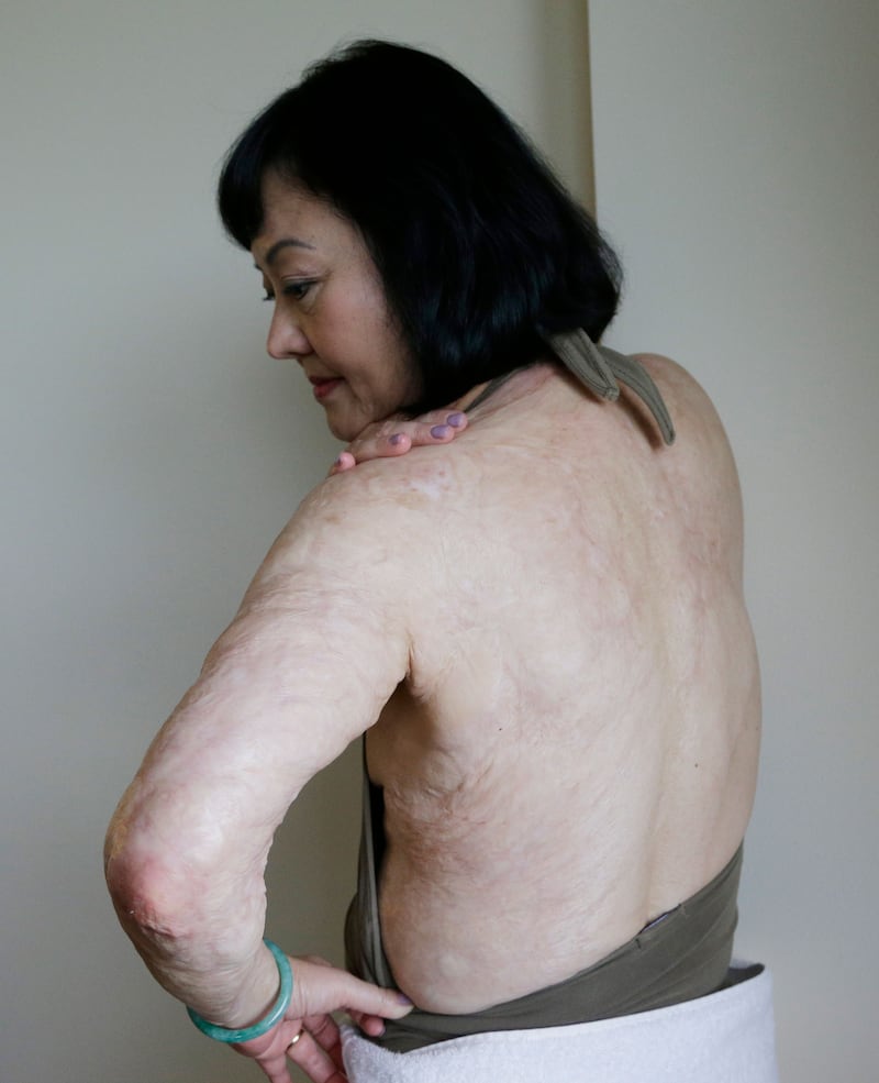 Kim Phuc showing napalm scars in 2015