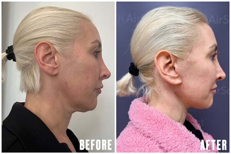 The Looker - Why This Cosmetic Surgeon Got a Facelift at 45