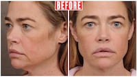 Denise Richards's face from two angles, prior to her face and neck lifts with Dr. Talei.