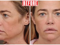 Denise Richards's face from two angles, prior to her face and neck lifts with Dr. Talei.