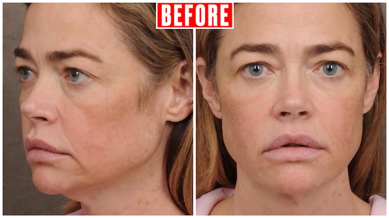 Denise Richards's face from two angles, prior to her face and neck lifts with Dr. Talei.