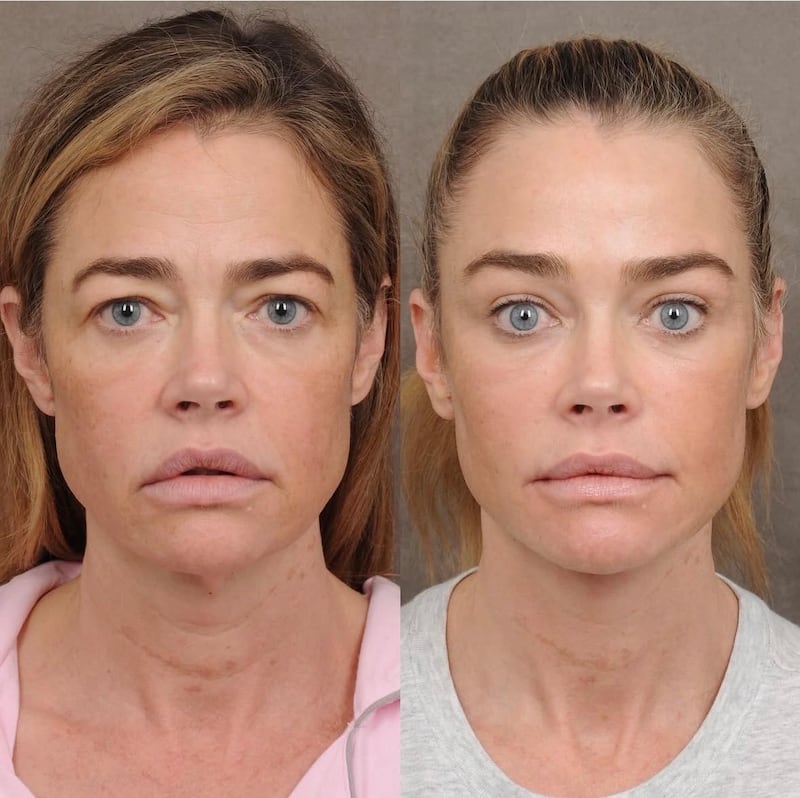 Denise Richards said she “did the whole thing.“ Pictured here before and after her facelift.