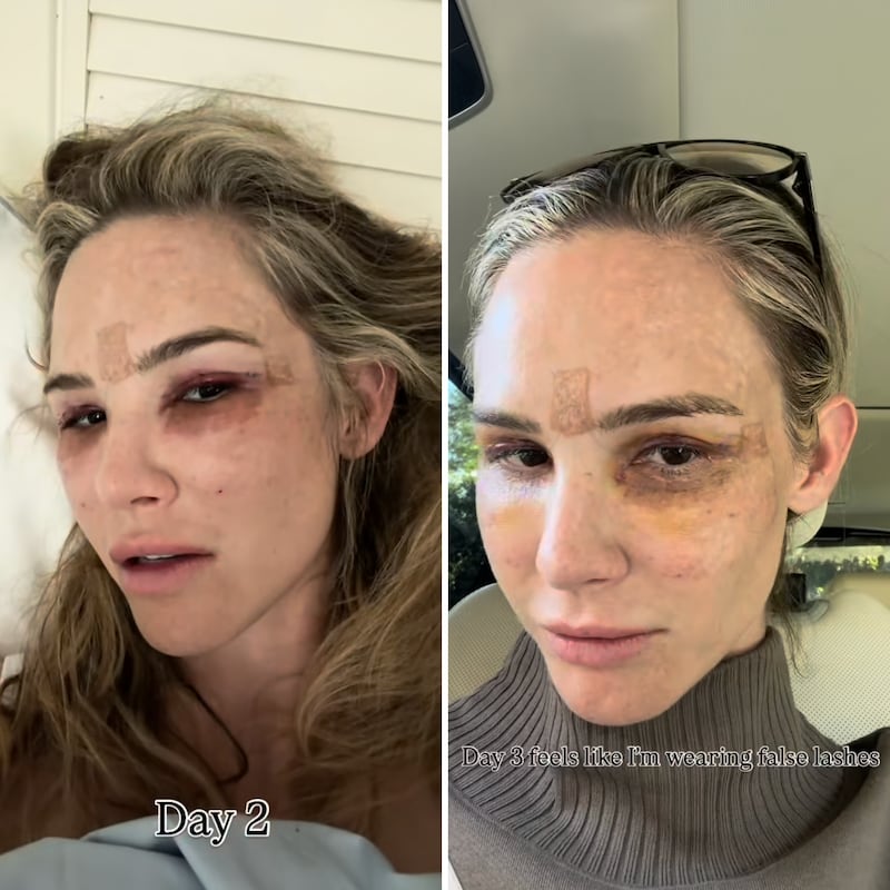 Meghan King's under-eyes were bruised in the first days following her surgery.