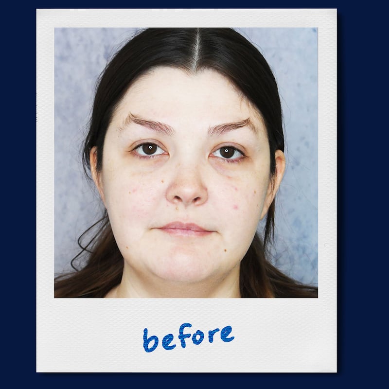 A photo illustration of chin lipo suction before and after for the Looker.