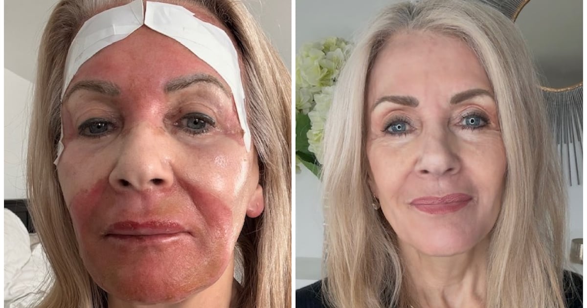 I’m 74, But the Needle-Free Croton Peel Makes Me Look Decades Younger