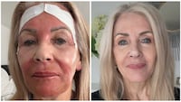 Pamela Allyn croton oil peel