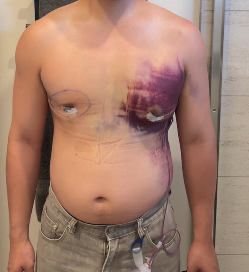 Jon Michael during recovery.