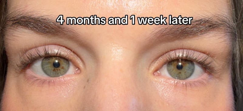 Over four months after the accident, Sarah Bell says she still experiences discomfort and inconsistent pupil sizes.