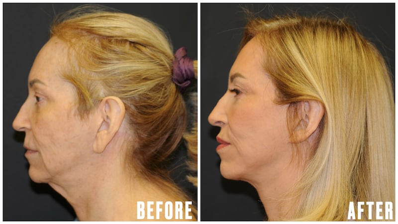 This Woman Underwent Surgery to Fix Common GLP-1 Side Effects - The Looker