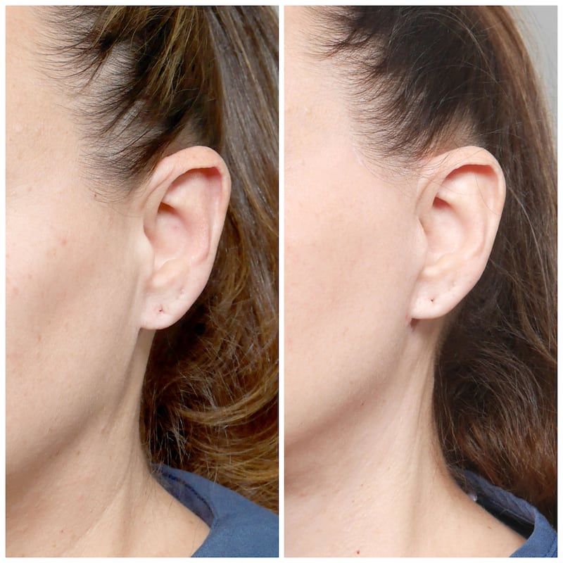 Leah got fat transferred into her lower earlobes during her facelift procedure.