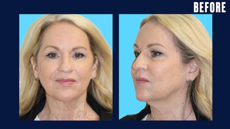 The Looker - This Woman's Facelift Had People Mistaking Her For Her Daughter
