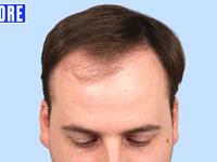 Jordan went through hair transplant surgery with Dr. Gary Linkov at Linkov Hair Surgery in New York City.