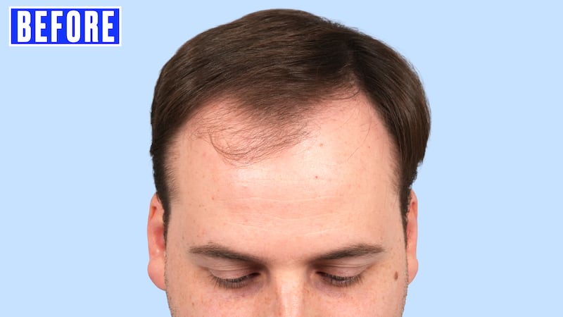 Jordan went through hair transplant surgery with Dr. Gary Linkov at Linkov Hair Surgery in New York City.