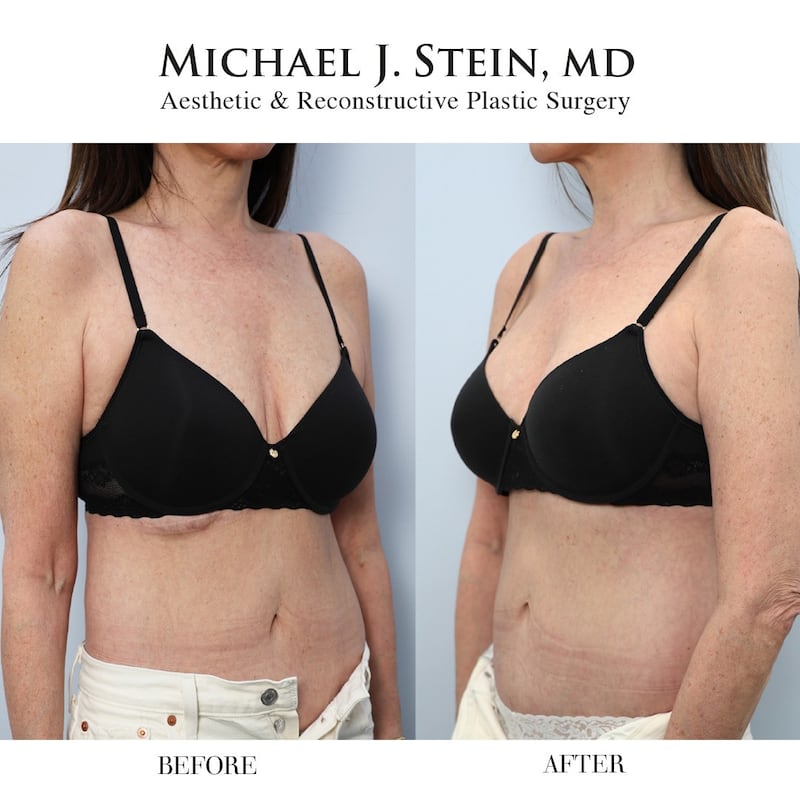 Jennifer Fessler underwent four breast augmentations before finally being pleased with her results after undergoing revision surgery with Dr. Michael Stein.