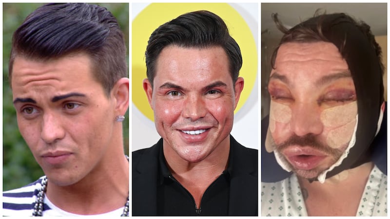 Bobby Norris at different stages of his plastic surgery and filler journey