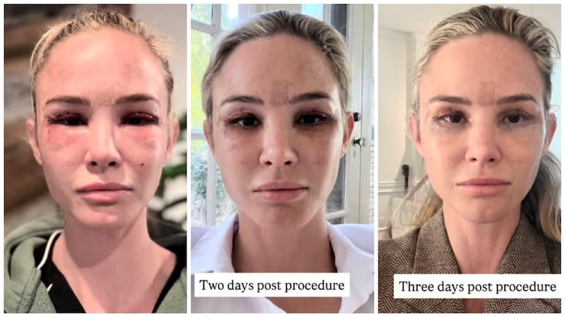 Meghan King showed her healing process from the first day to two weeks after.