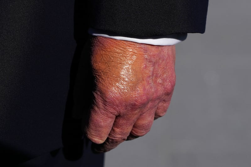 A view of President Donald Trump's left hand as he stops to speak to members of the media on the South Lawn of the White House on October 22, 2026 in Washington, DC.