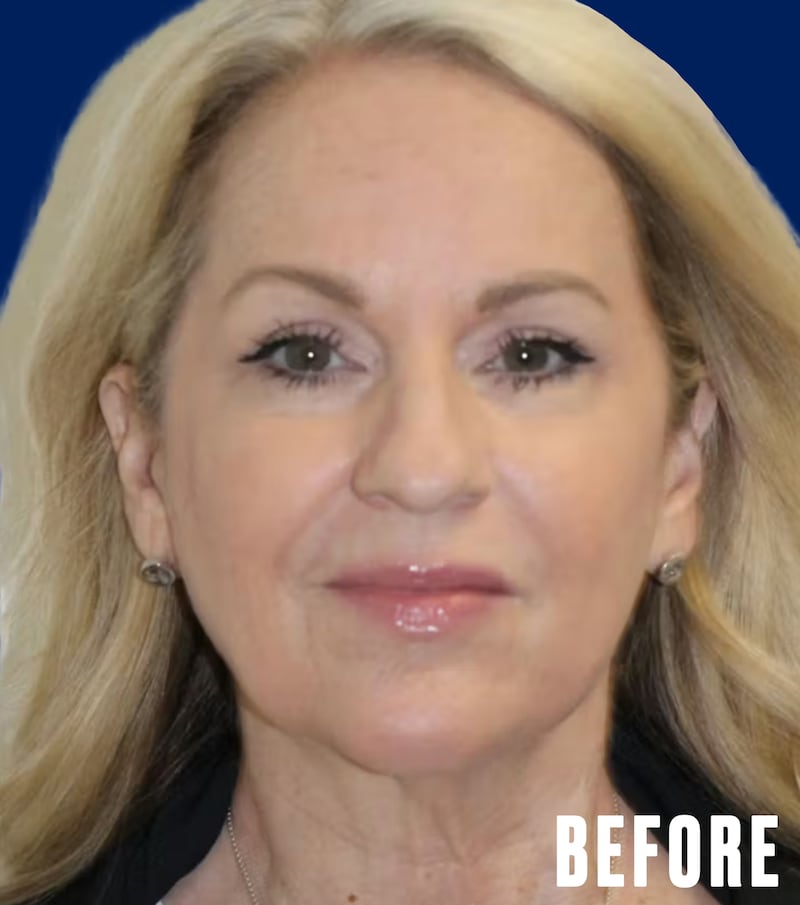 The Looker - This Woman's Facelift Had People Mistaking Her For Her Daughter