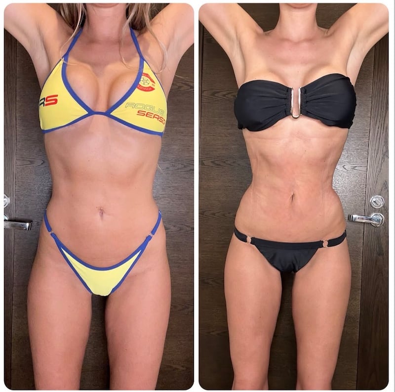 lli Dore underwent surgery to create “an hourglass waist.” The picture on the right shows her waist 5.5 weeks into recovery.
