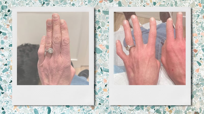 Before and after of filler use in the hand.