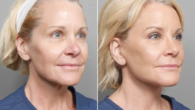 Deep plane face lift before and after. 3/4 view.