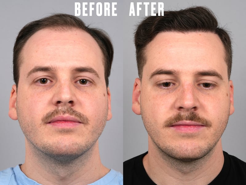 Jordan went through hair transplant surgery with Dr. Gary Linkov at Linkov Hair Surgery in New York City.