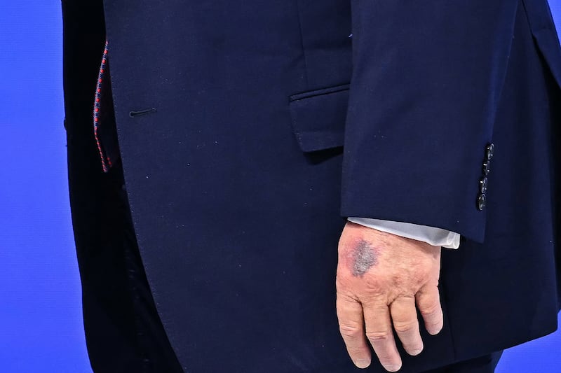 A bruise is visible on the back of President Donald Trump's left hand as he walks at the "Board of Peace" meeting during the World Economic Forum (WEF) annual meeting in Davos on January 22, 2026.