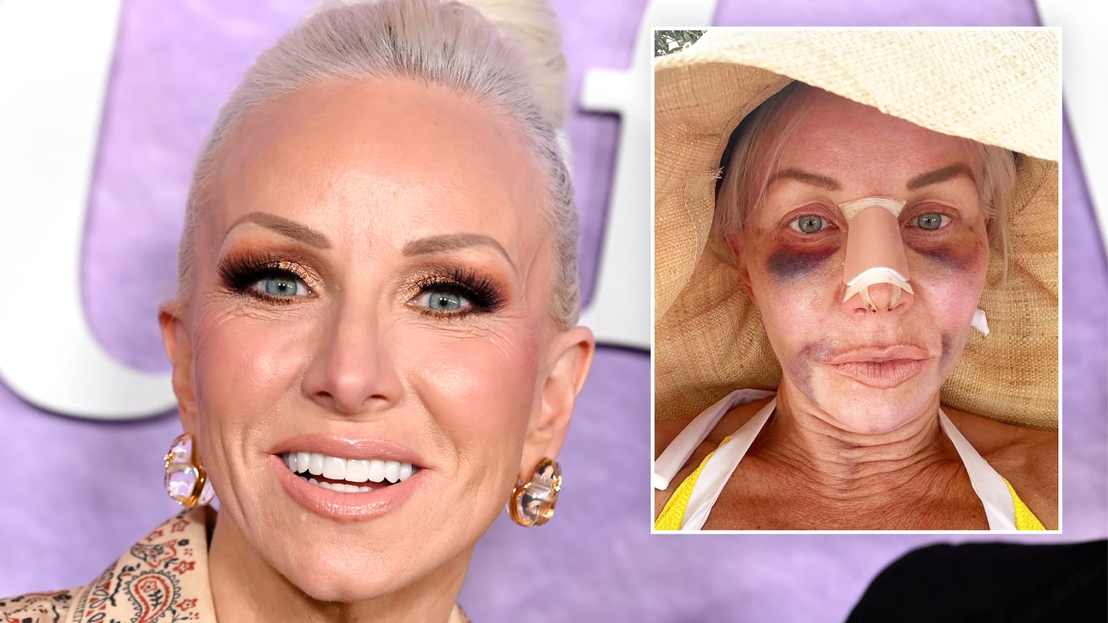 The Real Housewives of New Jersey star Margaret Josephs, 58, shared graphic pictures of her latest rhinoplasty, a fat transfer, and stem cell therapy.