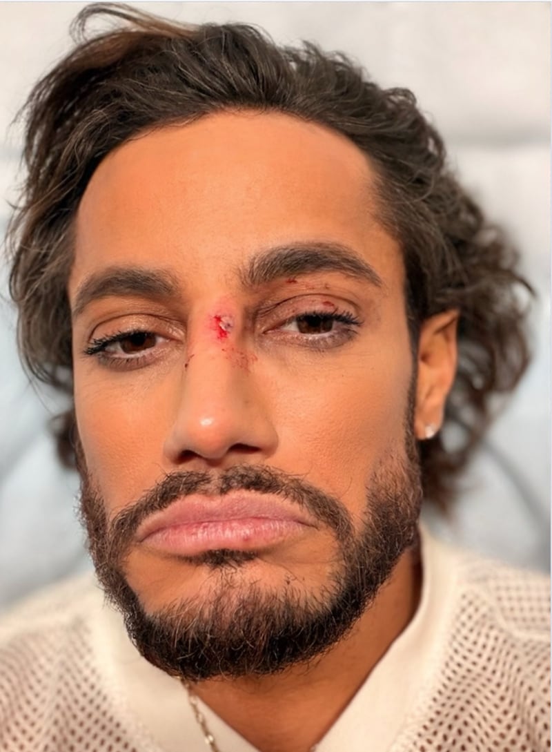 Frankie Grande shares an up-close photo of his face after being struck with a prop while performing on Broadway.