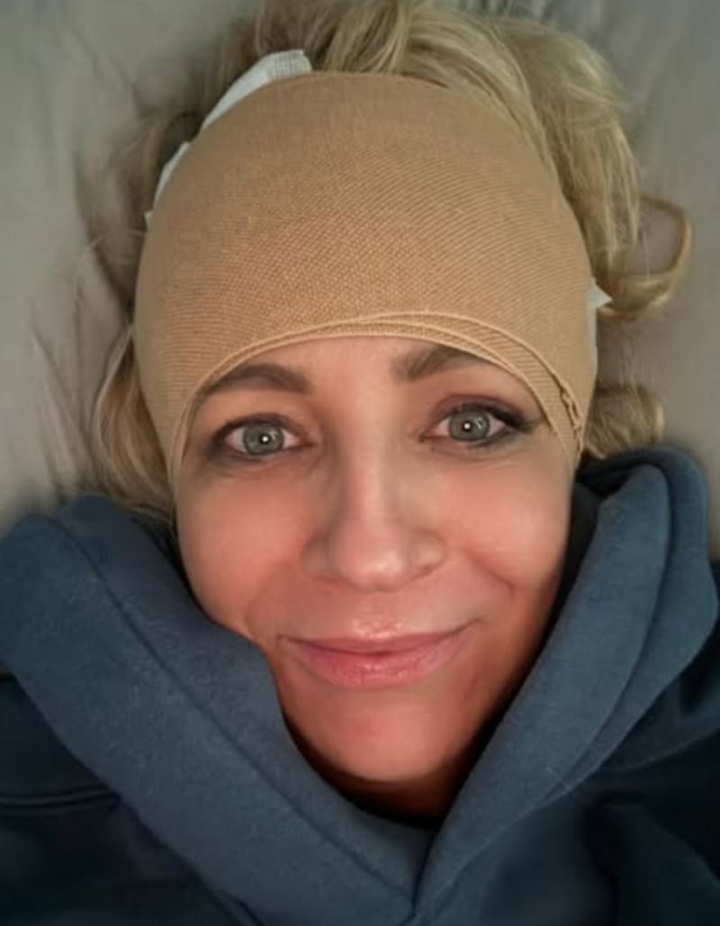 Carrie Bickmore showing her head injury as it heals