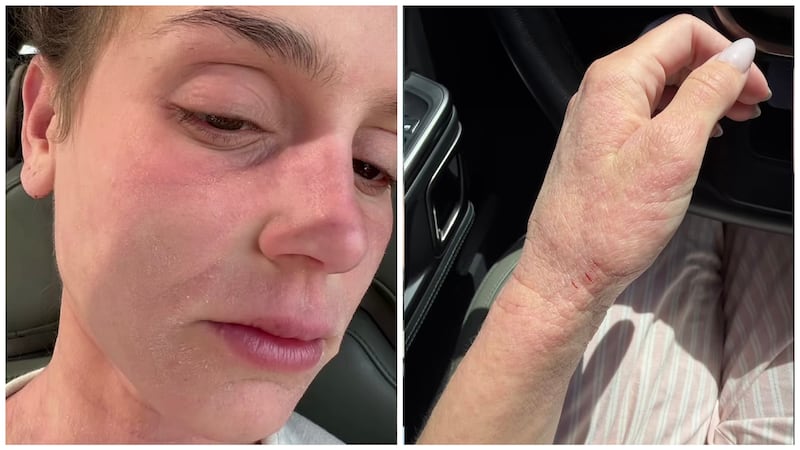 Mikayla Matthews shared pictures of her skin condition flaring up after returning home to Utah.