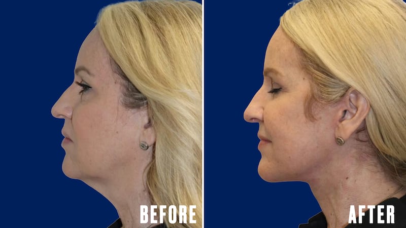 The Looker - This Woman's Facelift Had People Mistaking Her For Her Daughter